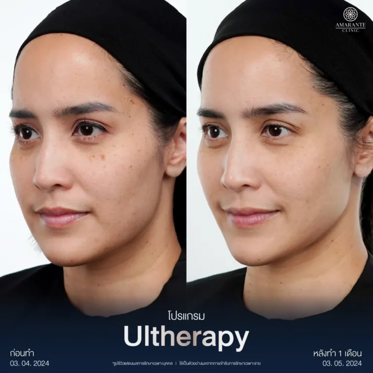 รวม BA Ultherapy-10