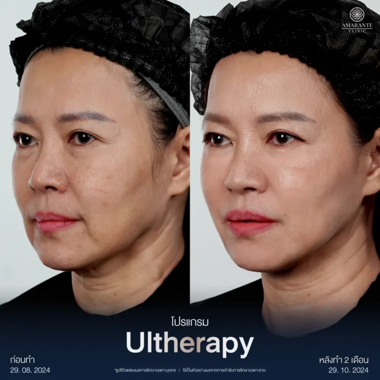 รวม BA Ultherapy-11