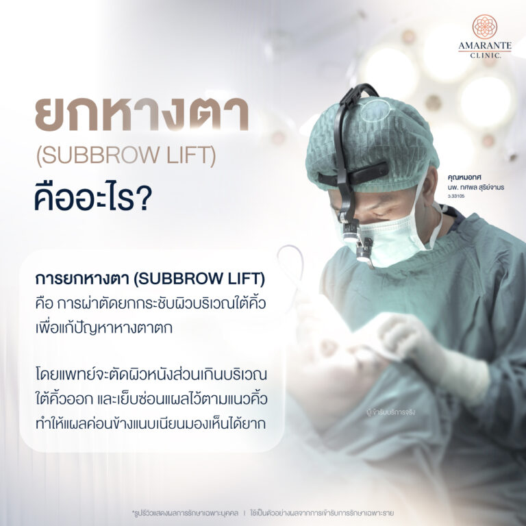 ยกหางตา (Sub Brow Lift) คืออะไร