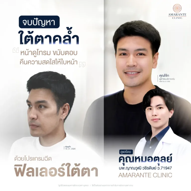 คุณโจ๊ก ภูริชจบปัญหาใต้ตาคล้ำ ด้วยการฉีดฟิลเลอร์ใต้ตาที่ Amarante Clinic