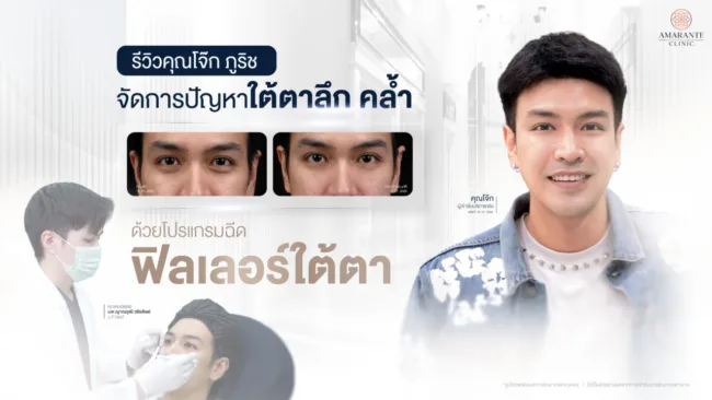รีวิว ฉีดฟิลเลอร์ใต้ตา - คุณโจ๊ก ภูริช