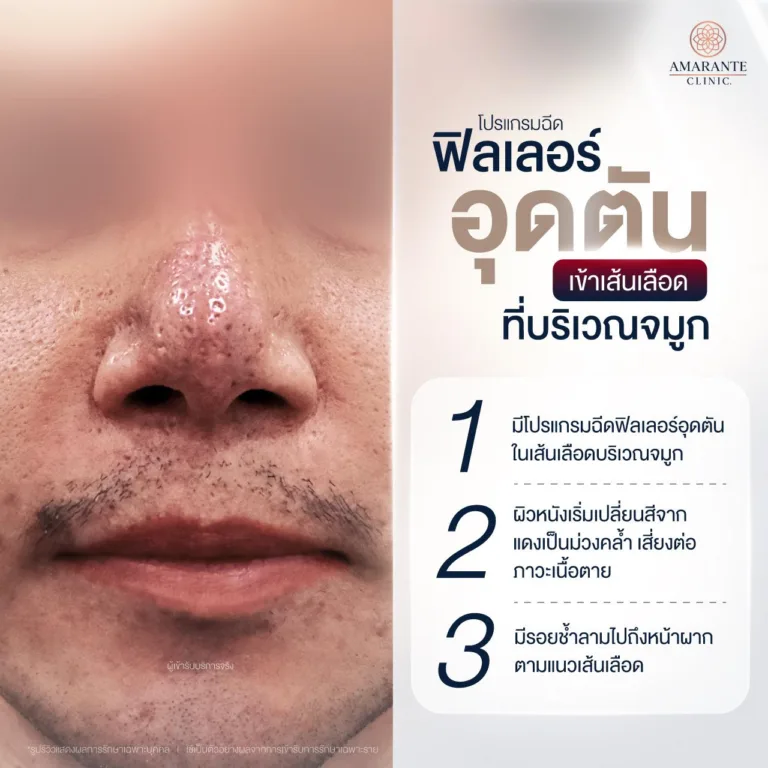 ฉีดฟิลเลอร์จมูกเข้าเส้นเลือด