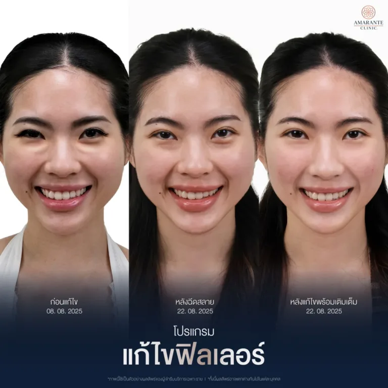 รีวิวฉีดสลายฟิลเลอร์เป็นก้อนใต้ตา