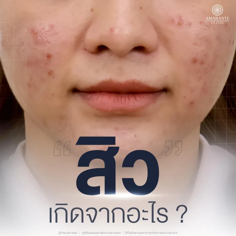 ปัจจัยที่ทำให้เกิดสิว มีอะไรบ้าง?