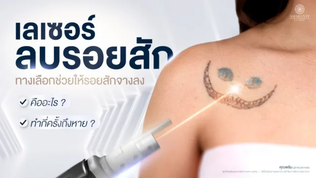 เลเซอร์ลบรอยสัก