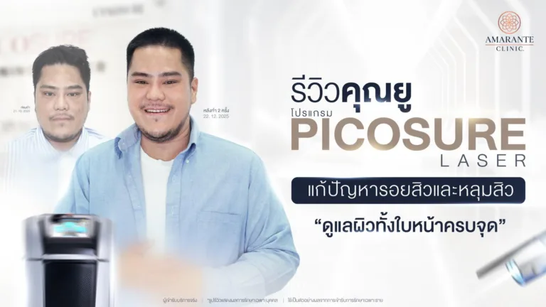 รีวิวรักษารอยสิว หลุมสิว ที่ Amarante Clinic
