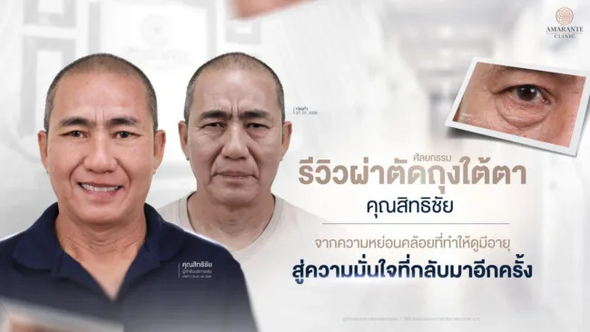 รีวิว ผ่าตัดถุงใต้ตา