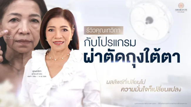 รีวิว ผ่าตัดถุงใต้ตา
