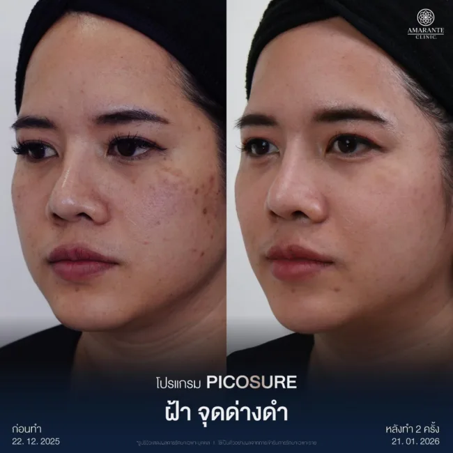 รีวิว รักษาฝ้าด้วย Picosure Pro Laser