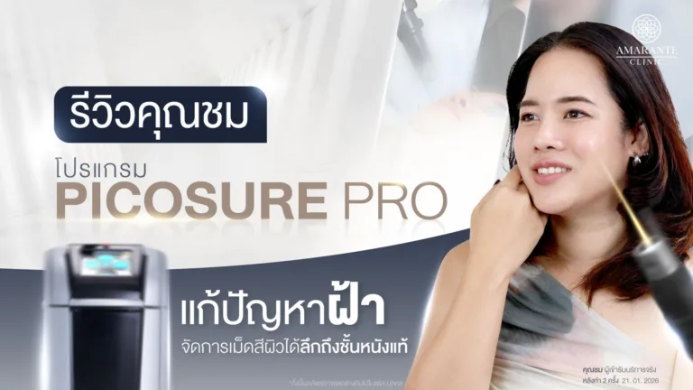 รีวิวรักษาฝ้าด้วย Pico Laser