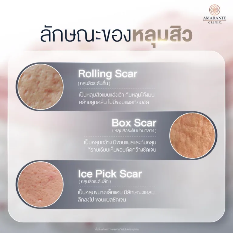 ลักษณะหลุมสิว ที่สามารถรักษารอยหลุมสิวได้