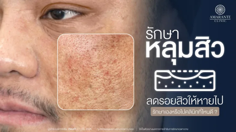 รักษาหลุมสิว