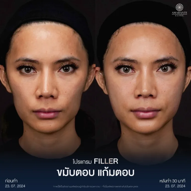 รีวิวฉีดฟิลเลอร์ขมับ