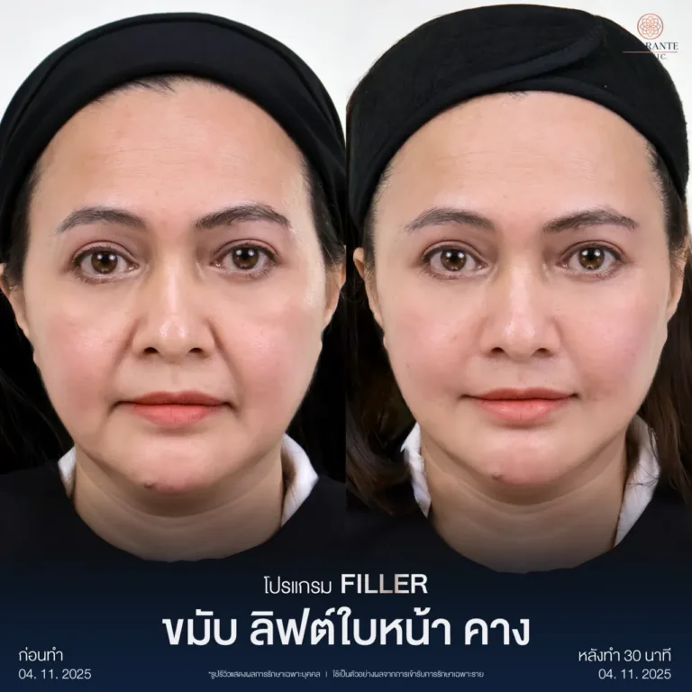 รีวิวฉีดฟิลเลอร์ขมับ