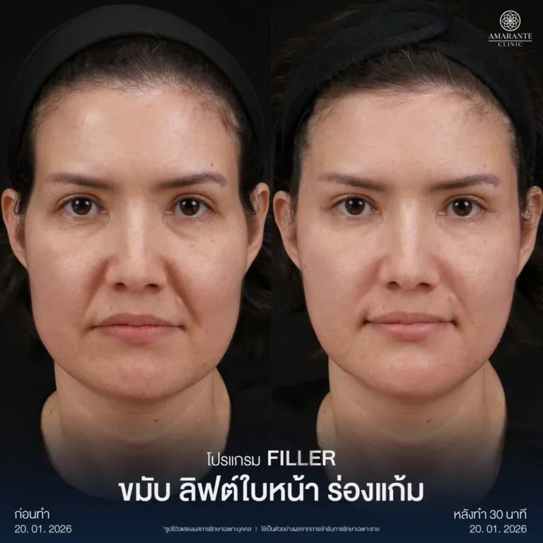 รีวิวฉีดฟิลเลอร์ขมับ