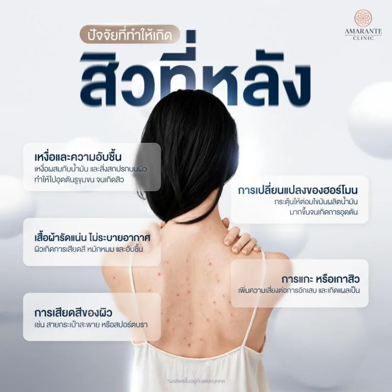 ปัจจัยที่ทำให้เกิดสิวที่หลัง