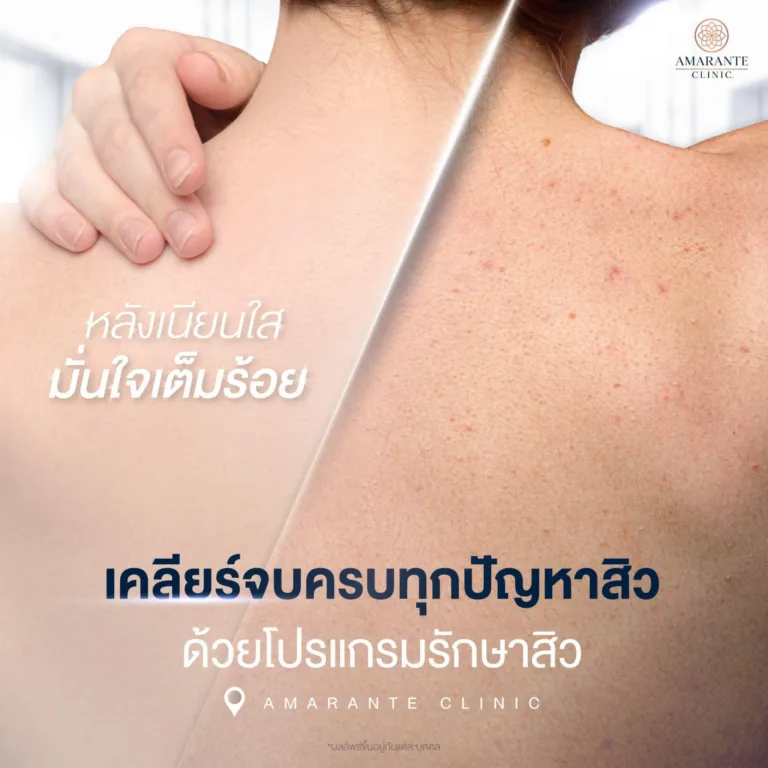 โปรแกรมรักษาสิวที่ Amarante Clinic