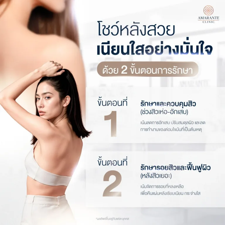 วิธีรักษาสิวที่หลัง และ วิธีรักษารอยสิวที่หลัง