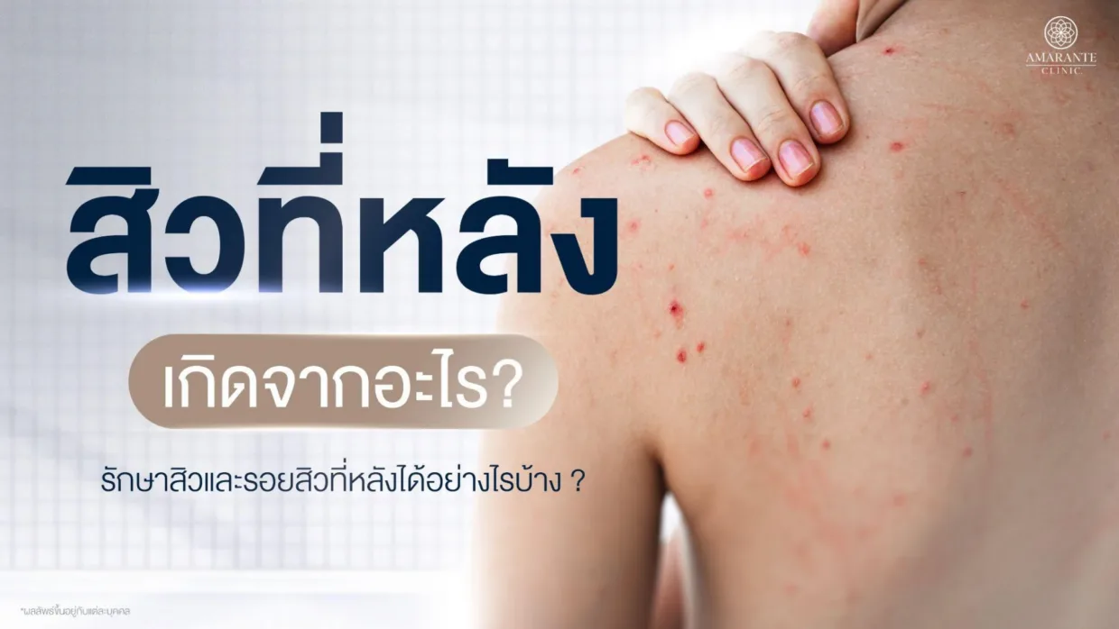 วิธีรักษาสิวที่หลัง