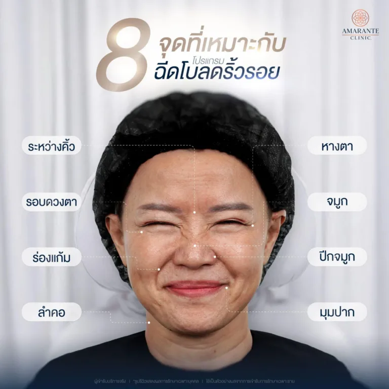 ฉีดโบท็อกลดริ้วรอย ฉีดจุดไหนได้บ้าง