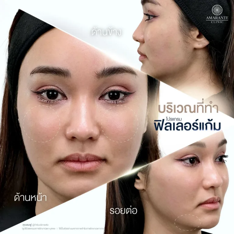 ฉีดฟิลเลอร์แก้มบริเวณไหนได้บ้าง