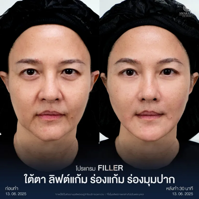 รีวิวฉีดฟิลเลอร์ร่องแก้ม และ ฉีดฟิลเลอร์ลิฟต์แก้ม