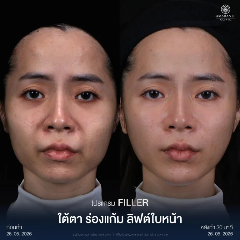 รีวิวฉีดฟิลเลอร์ร่องแก้ม