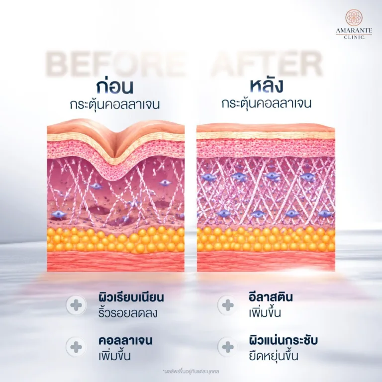 กระตุ้นคอลลาเจน ช่วยอะไร