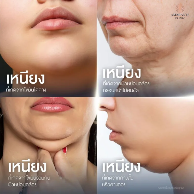 ประเภทของเหนียง