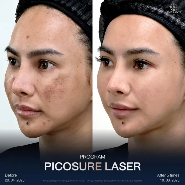 แก้หน้าโทรมด้วยเลเซอร์ฝ้า Pico Laser ที่ Amarante Clinic