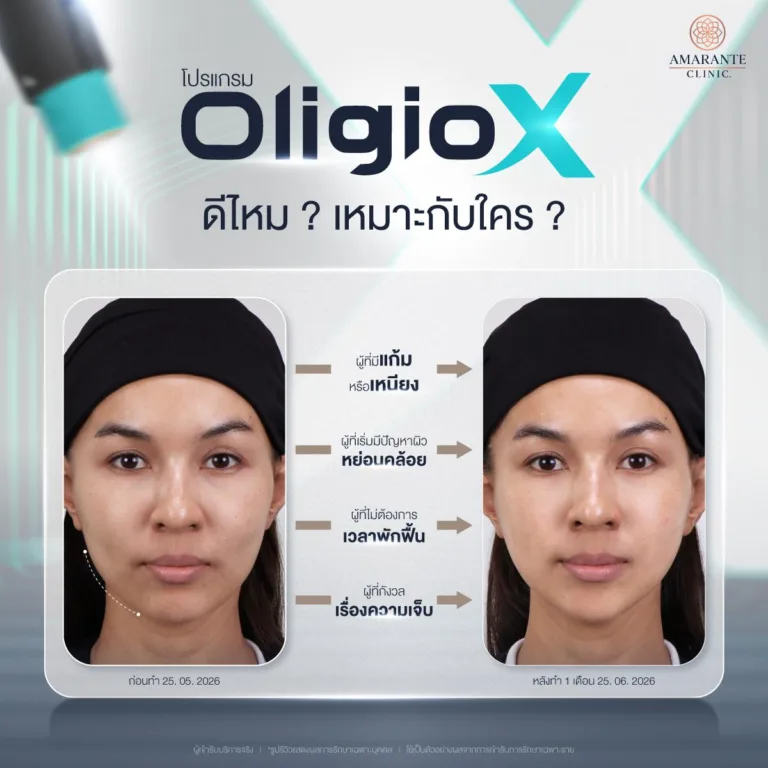 Oligio X เหมาะกับใคร