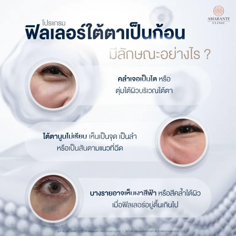 ฟิลเลอร์ใต้ตาเป็นก้อน