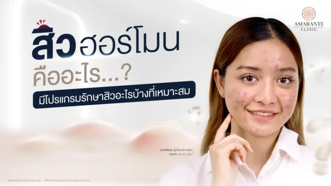 สิวฮอร์โมน คืออะไร