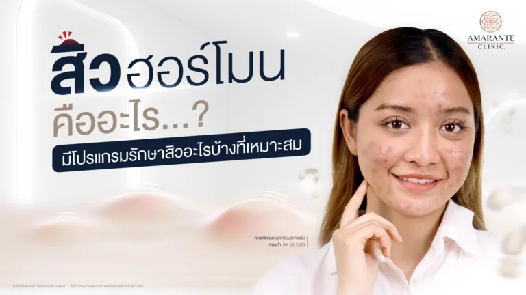 สิวฮอร์โมน คืออะไร
