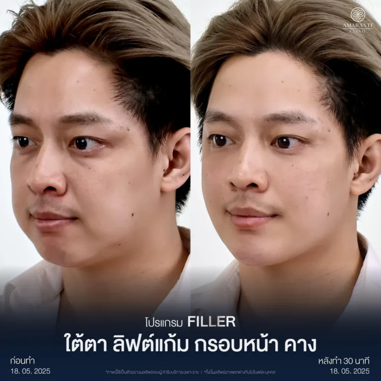 รีวิว กั๊ก เล้าโลม ฮีดฟิลเลอร์ที่ Amarante Clinic
