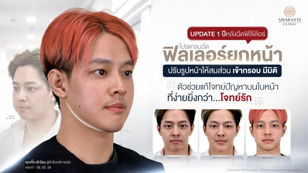 รีวิวฟิลเลอร์ยกหน้า กั๊ก เล้าโลม
