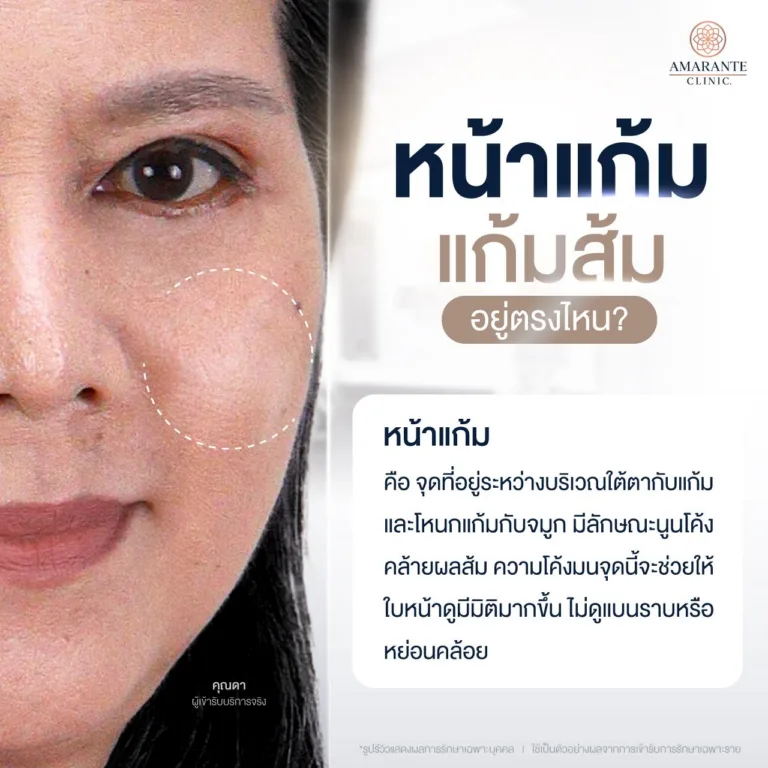 พื้นที่บริเวณที่ฉีดฟิลเลอร์หน้าแก้ม