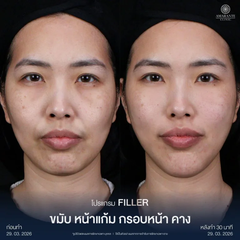 รีวิวฉีดฟิลเลอร์หน้าแก้มที่ Amarante Clinic
