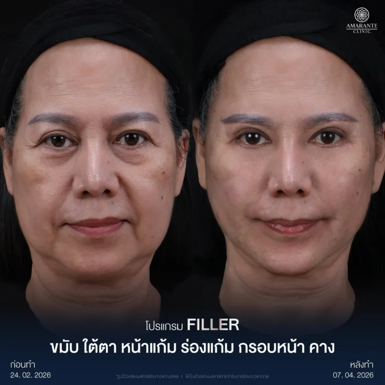 รีวิวฉีดฟิลเลอร์หน้าแก้มที่ Amarante Clinic