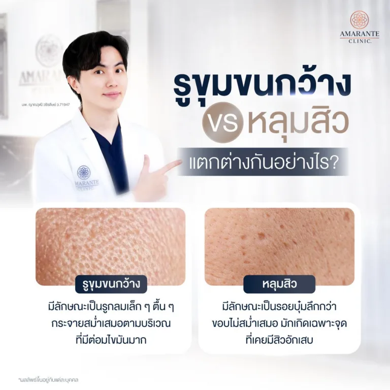 รูขุมขนกว้าง VS หลุมสิว