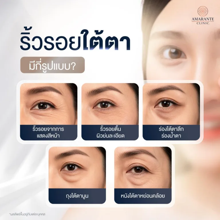 ลักษณะของริ้วรอยใต้ตา