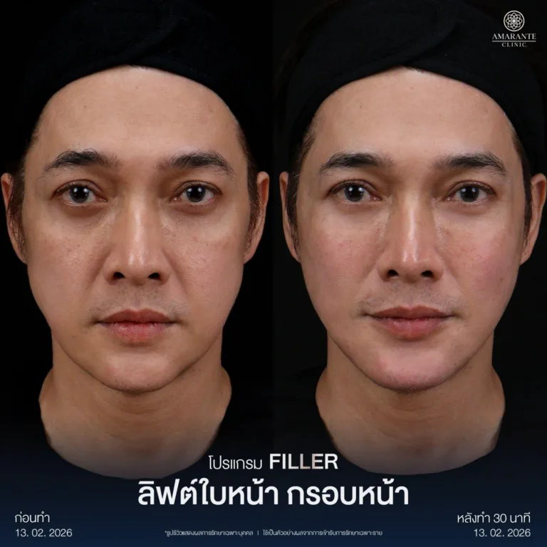 รีวิวฉีดฟิลเลอร์ยกหน้า