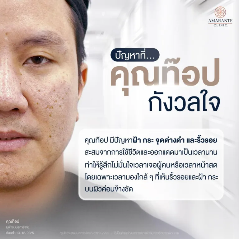 คุณท๊อป มารักษาด้วยเลเซอร์ฝ้า กระ