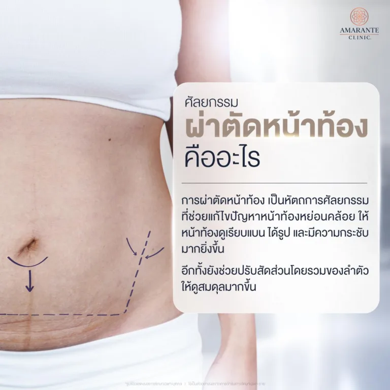 ผ่าตัดหน้าท้อง คืออะไร
