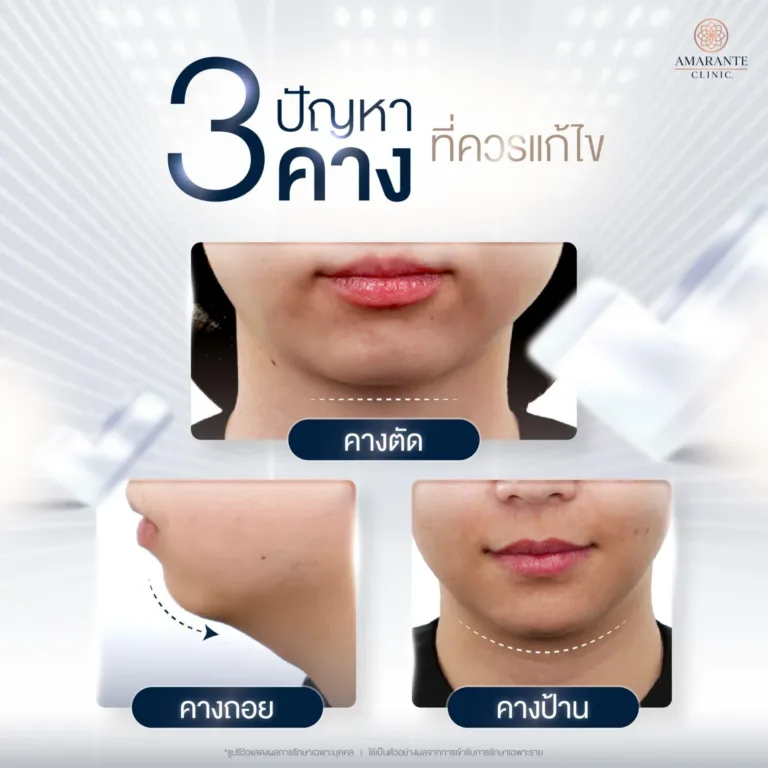 ปัญหาคาง ที่ควรเลือกว่า ฉีดฟิลเลอร์คาง หรือ ผ่าตัดเสริมคาง ดีกว่ากัน