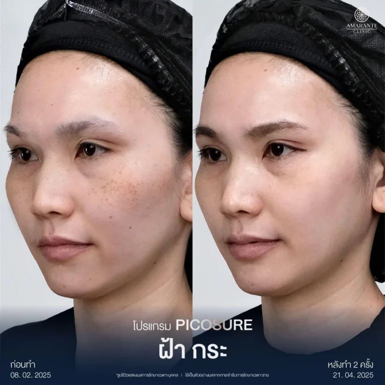 รีวิว เลเซอร์หน้าใส รักษา ฝ้า และ กระ