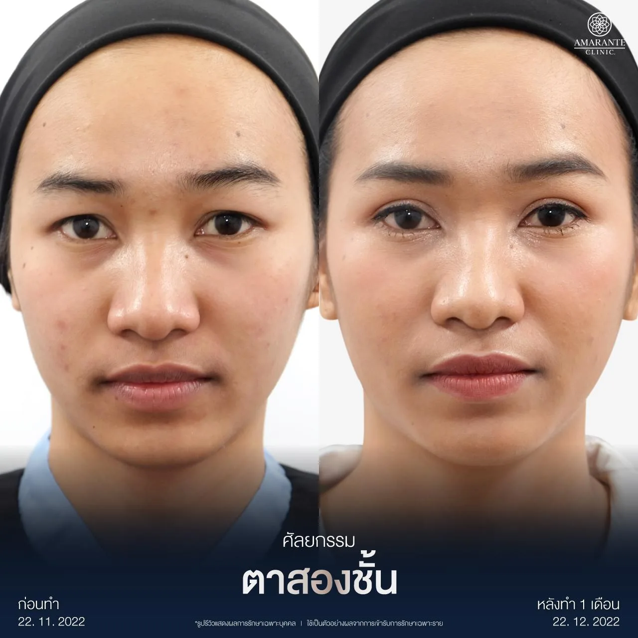 รีวิวตาสองชั้นกรีดยาว
