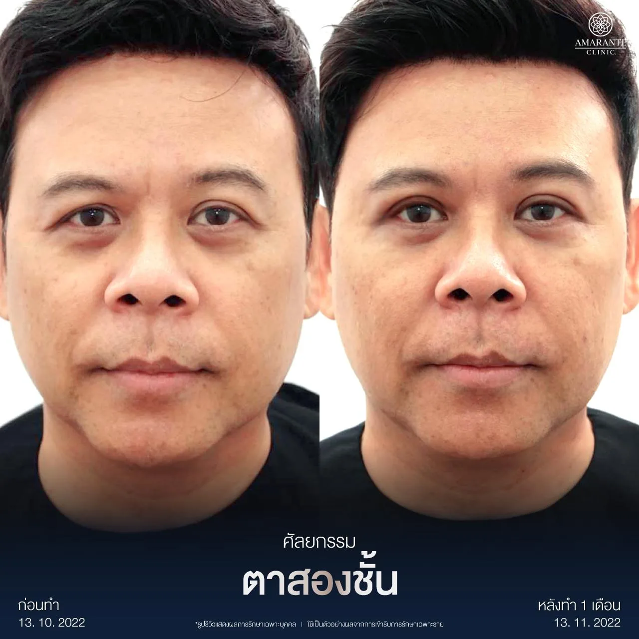 รีวิวทำตาสองชั้น แบบกรีดยาว