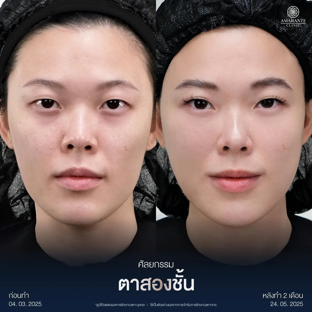 รีวิวผ่าตัดตาสองชั้น กรีดยาว