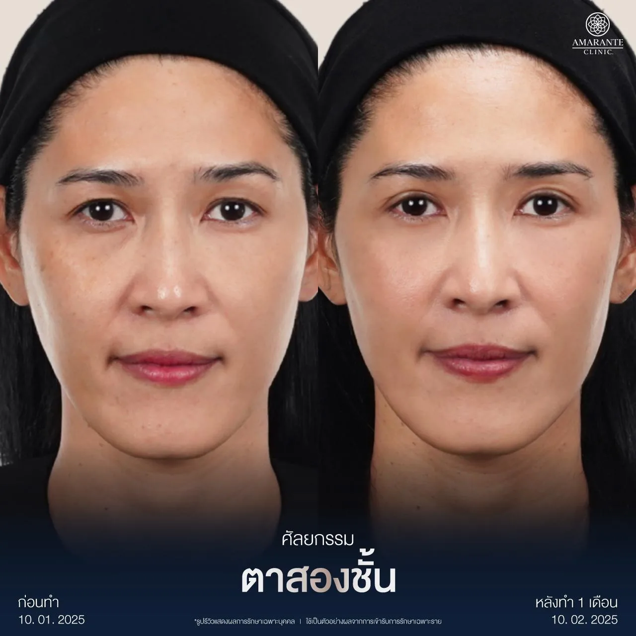 รีวิวทำตาสองชั้น ด้วยเทคนิคกรีดยาว